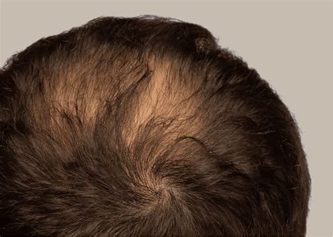 Crown Hair Patch For Thinning Or Balding | ubicaciondepersonas.cdmx.gob.mx