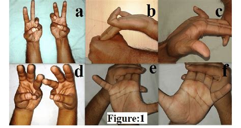 (a) Schaeffer's test demonstrating the presence of palmaris longus ...