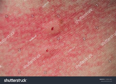 34 Spider Insect Bite Rash Images, Stock Photos & Vectors | Shutterstock