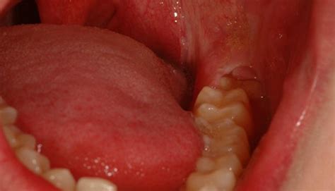 Pericoronitis: Symptoms, Causes, Treatment, and Home Remedies - SmilesCare - Dental education ...