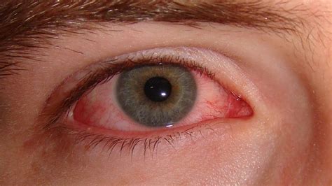 Ways to Care Your Eyesight: Different Symptoms of Red Eyes disease with pictures