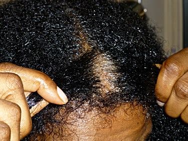 How to Treat Dry Scalp in African American Hair • DryScalpGone