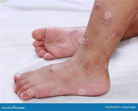 Hfmd Hand Foot Mouth Virus Red Blisters on Both Legs and Feet Epidemic in Sick Children Painful ...