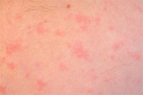 Food Allergy Skin Rash Images