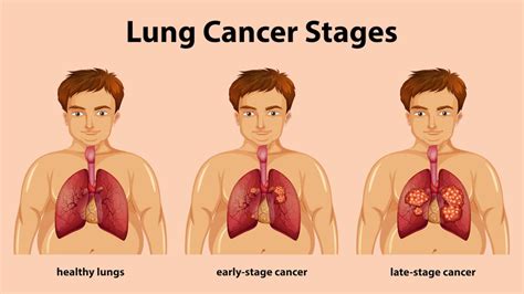 Four Stages Of Lung Cancer Disease Stock Vector Illus - vrogue.co
