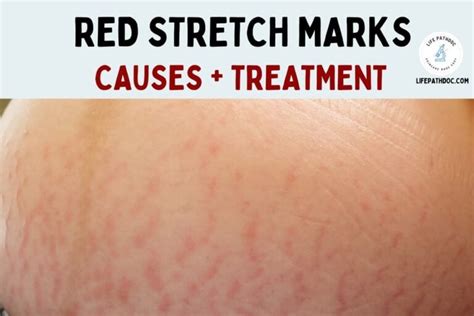 Red Stretch Marks (Striae rubra): Causes & How to Treat Them