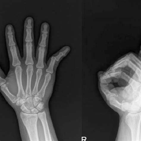 Radiographs at the presentation show double dislocations of the ...