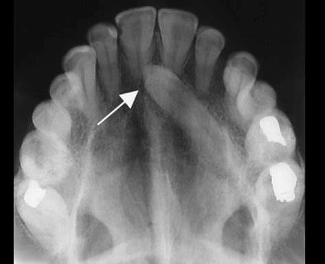 Panoramic radiograph of a 46-year-old male with a left maxillary canine ...