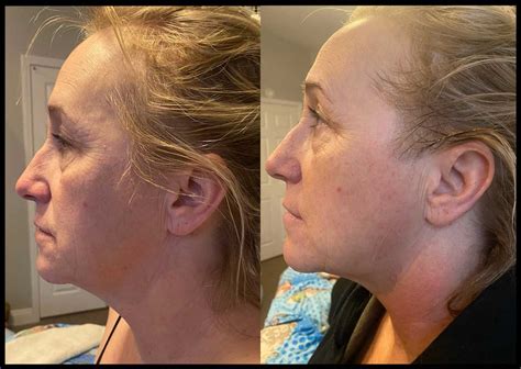 CryoSlimming, CryoToning, and CryoFacial Results | NorCal CryoSlim