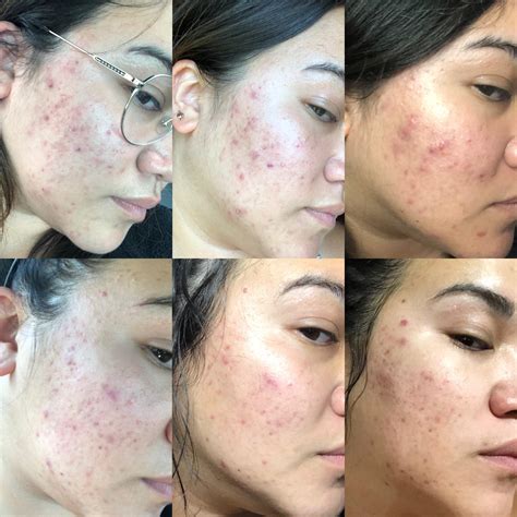 1 month of spironolactone 100 mg progress : r/acne