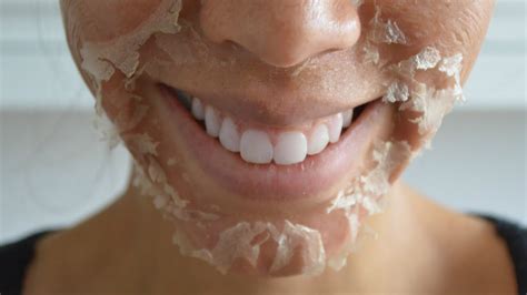 Face Skin Peeling After Moisturizer at Amy Beaudry blog