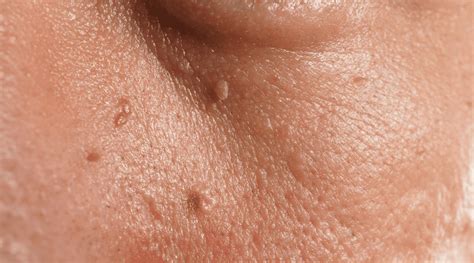 Understanding Skin Tags: Causes and Treatment Options - SBA Dermatology