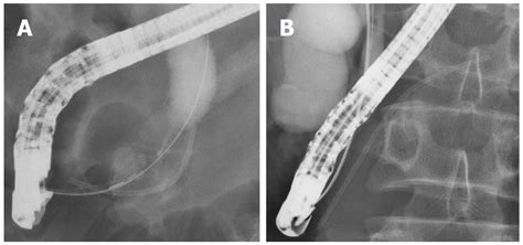 Pancreatic stents for the prevention of post-endoscopic retrograde ...