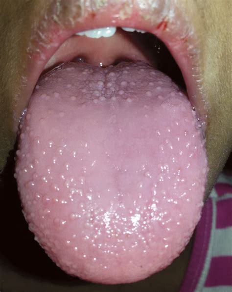 strawberry tongue pictures - pictures, photos