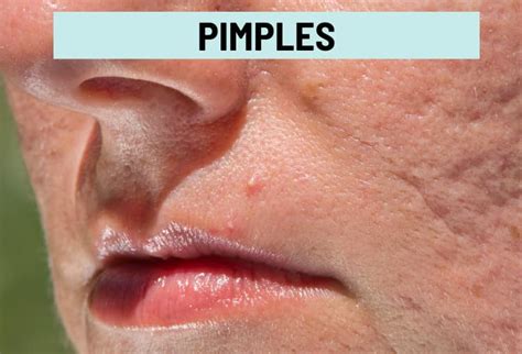 Cold Sore vs. Pimple: Pictures and Differences