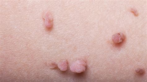 8 natural ways to get rid of skin tags | Starts at 60