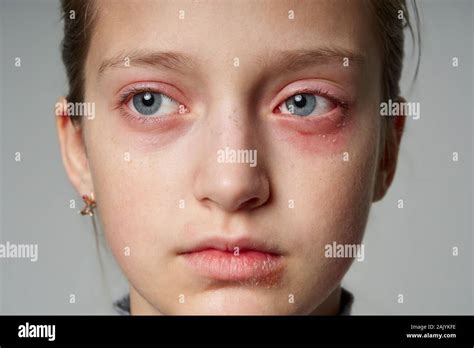 Allergic reaction, skin rash, close view portrait of a girl's face ...