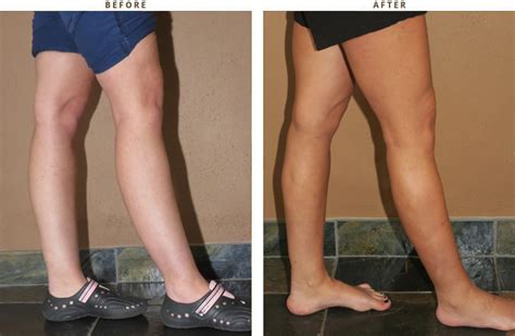 Calf Augmentation - Before and After Pictures * | Dr Turowski - Plastic Surgery Chicago