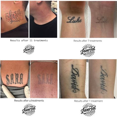 Top 77+ laser tattoo removal before and after latest - in.cdgdbentre