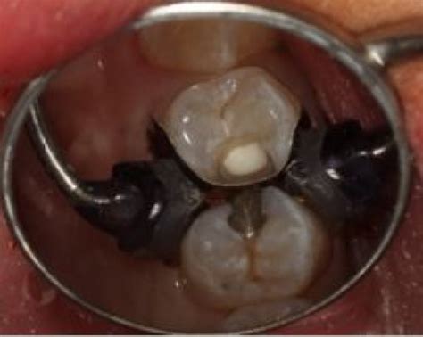 Two Methods of Indirect Pulp Capping For Removing Caries - Spear Education