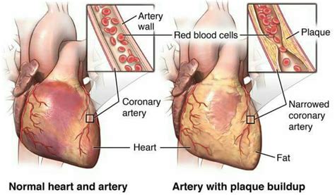 Myocardial Ischemia: Causes, Symptoms And Treatment, 41% OFF