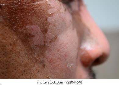 Burnsit Scar Burn Which Bathed Boiling Stock Photo 722044648 | Shutterstock