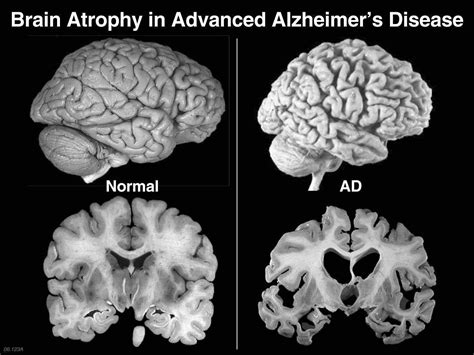 brain atrophy side and front | b-reddy.org