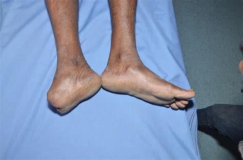 TRAUMATIC AMPUTATION OF MIDFOOT | CRUSH INJURY FOOT, LOWER LIMB INJURIES AND LIMB SALVAGE