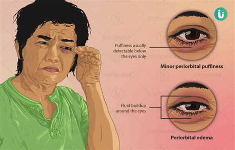 Swollen Eyes: symptoms, causes, treatment, medicine, prevention, diagnosis