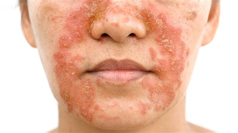 Skin Rash On One Side Of Face | Allergy Trigger