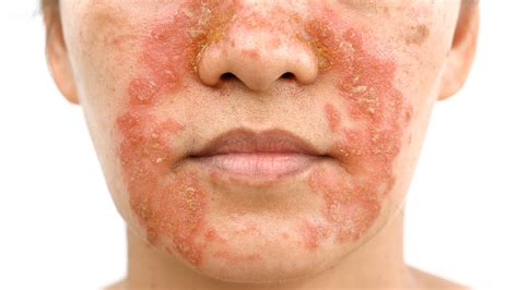 Skin Rash On One Side Of Face | Allergy Trigger