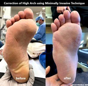 High arch is causing my foot problems. What is the solution? - CNOS