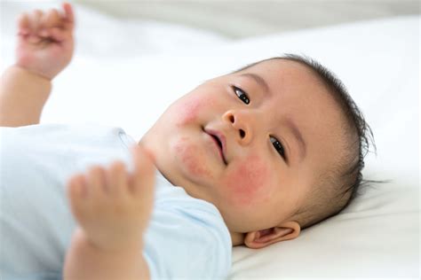 Skin Allergies In Children – Dr. HM Liew Skin Clinic