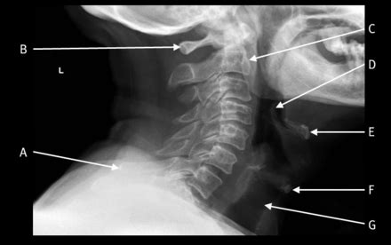 Lateral plain radiograph of the cervical spine | The BMJ