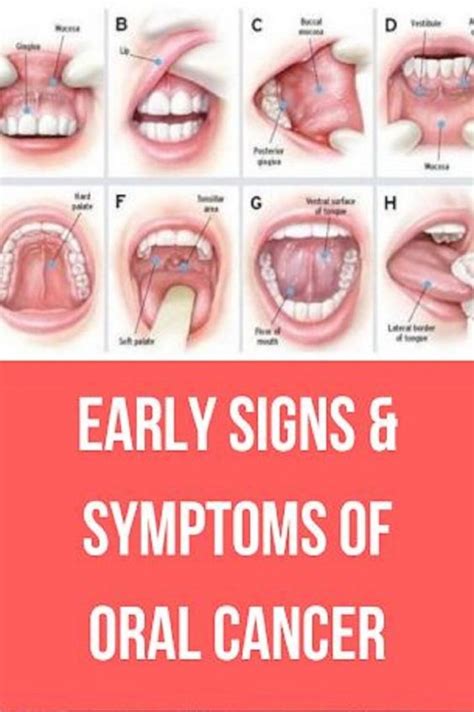 Early Signs & Symptoms of Oral Cancer | Guide To Health