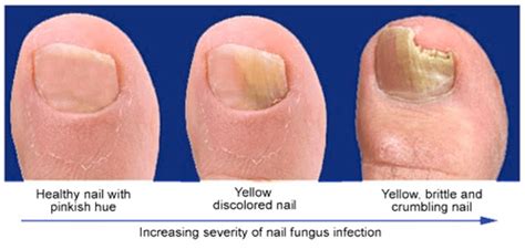 Mild Toe Fungus Treatment