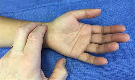 Radial Pulse | Hand Surgery Resource