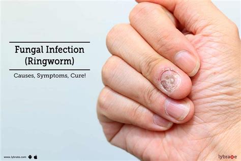 Fungal Infection (Ringworm): Causes, Symptoms, Cure! - By Dr. Ramya M N | Lybrate