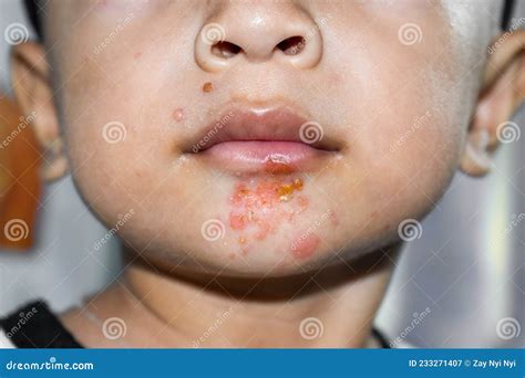 Staphylococcal Skin Infection Called Impetigo Around Mouth Stock Image - Image of lesion, skin ...