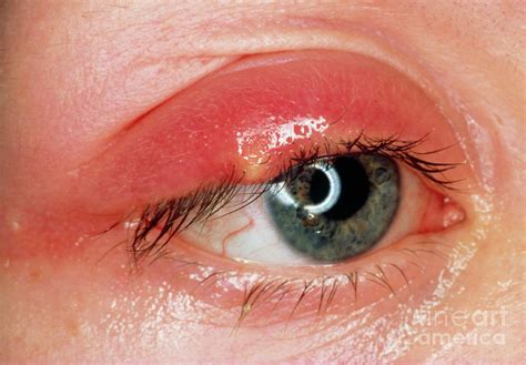 Chalazion Bumps On Upper Eyelid | lupon.gov.ph