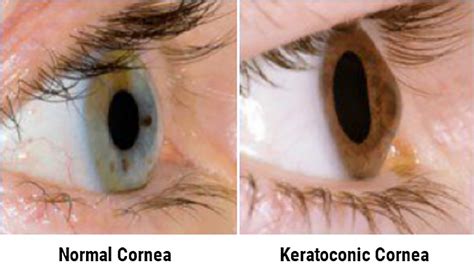 Keratoconus Treatment DC & MD | Keratoconus Specialists