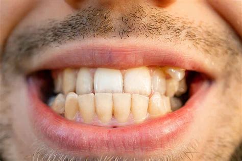 What Is a Crossbite? - Milnor Orthodontics