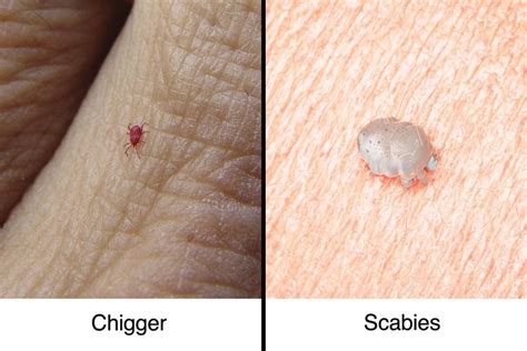 Chigger Bites vs. Scabies: How to Tell the Difference | The Healthy