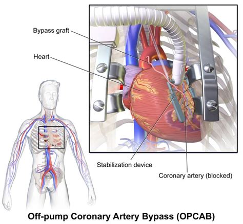 Heart Surgery Types - Open, Bypass, Ablation, Heart Valve surgery