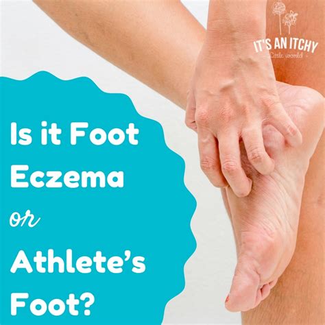 Is it Foot Eczema or Something Else? - It's an Itchy Little World