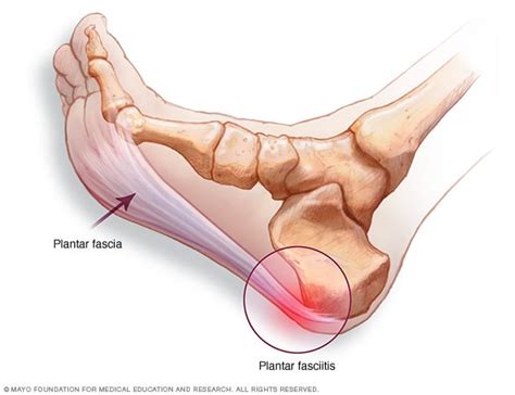 Relieve Foot Pain Fast By Using These Proven Plantar Fasciitis ...