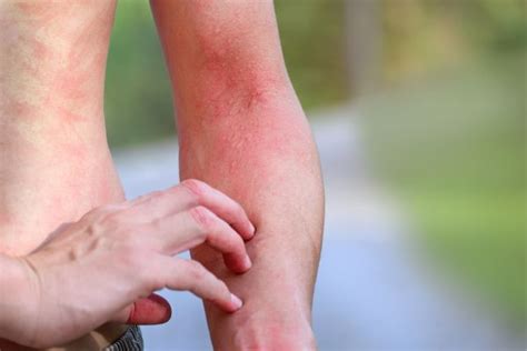 Fire Ant Bites: Treatment And Relief From The Itch - EFI