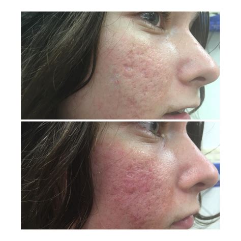 CO2 laser in treating acne scars – ultrapulse & Subcision of Acne Scars ...