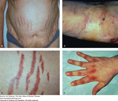 Cushing Syndrome | AccessMedicine Network