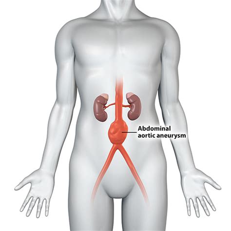 Abdominal Aortic Aneurysm Treatment Sydney | Thoracic Aorta (TAA) Sydney